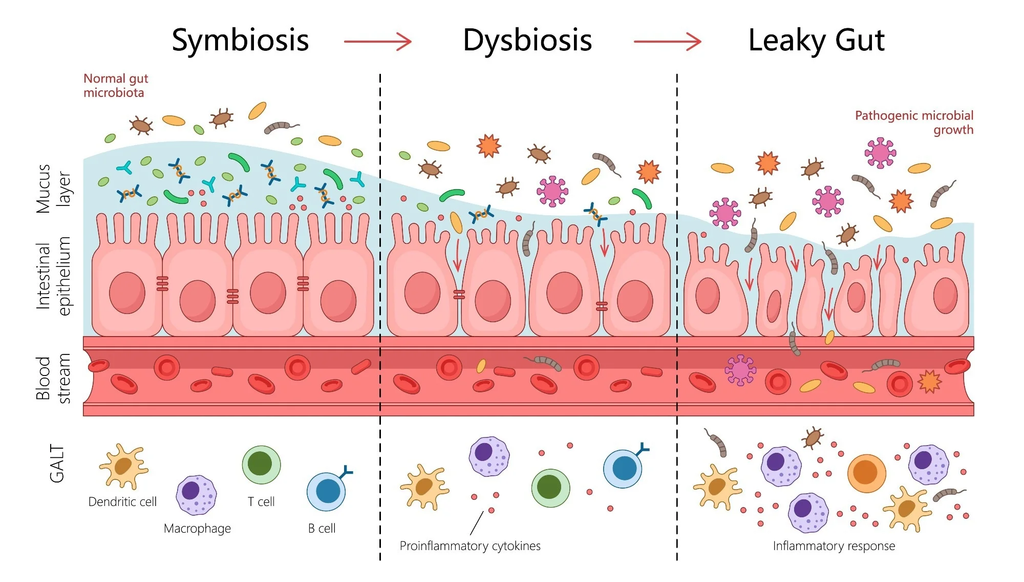 steps towards leaky gut, going from symbiosis to dysbiosis